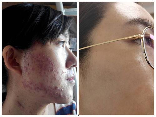 痘痘肌肤照片,成因与改善之道